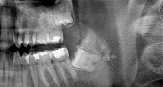 Poluimpaktirani/impaktirani treći molari (umnjaci)