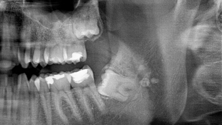 Poluimpaktirani/impaktirani treći molari (umnjaci)