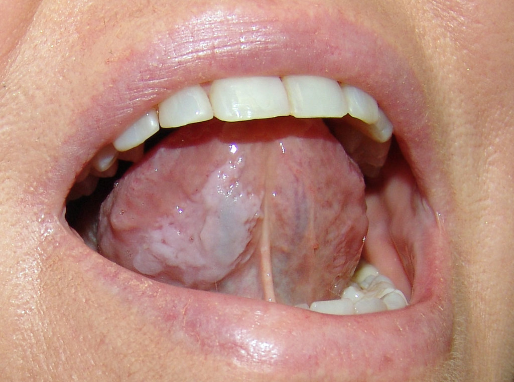 Leukoplakia