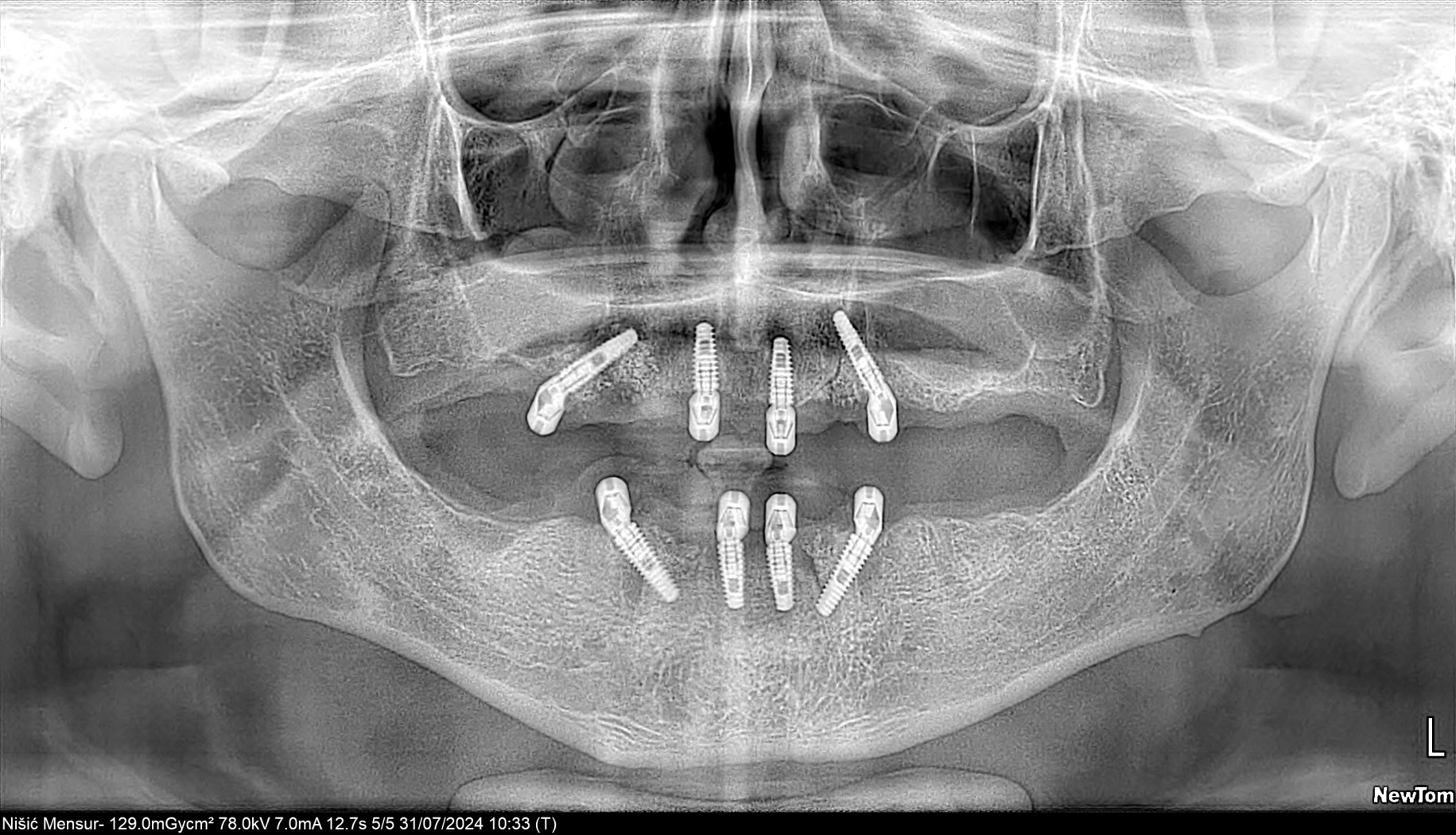 OPG snimak nakon ugradnje implantata