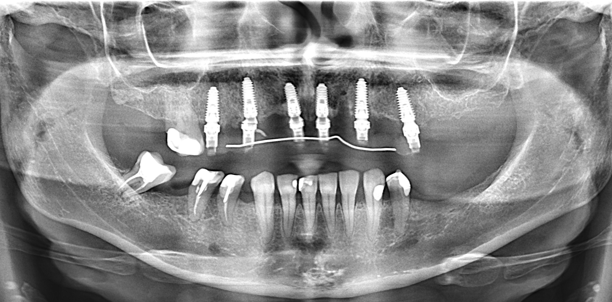 OPG snimak nakon ugradnje implantata